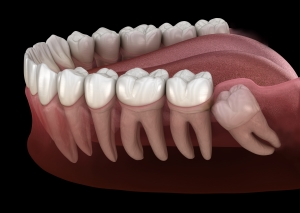 Wisdom Tooth Treatment at Sandgate Dental near Redcliffe