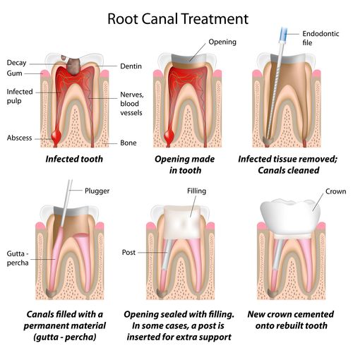 Root Canal Treatment Process