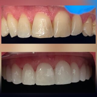 Real patient photos showcasing the transformation with porcelain veneers: Before and After 