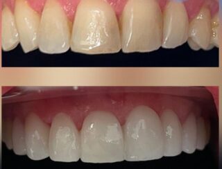 before and after porcelain veneers