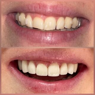 porcelain veneers before and after