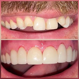 porcelain veneers before and after